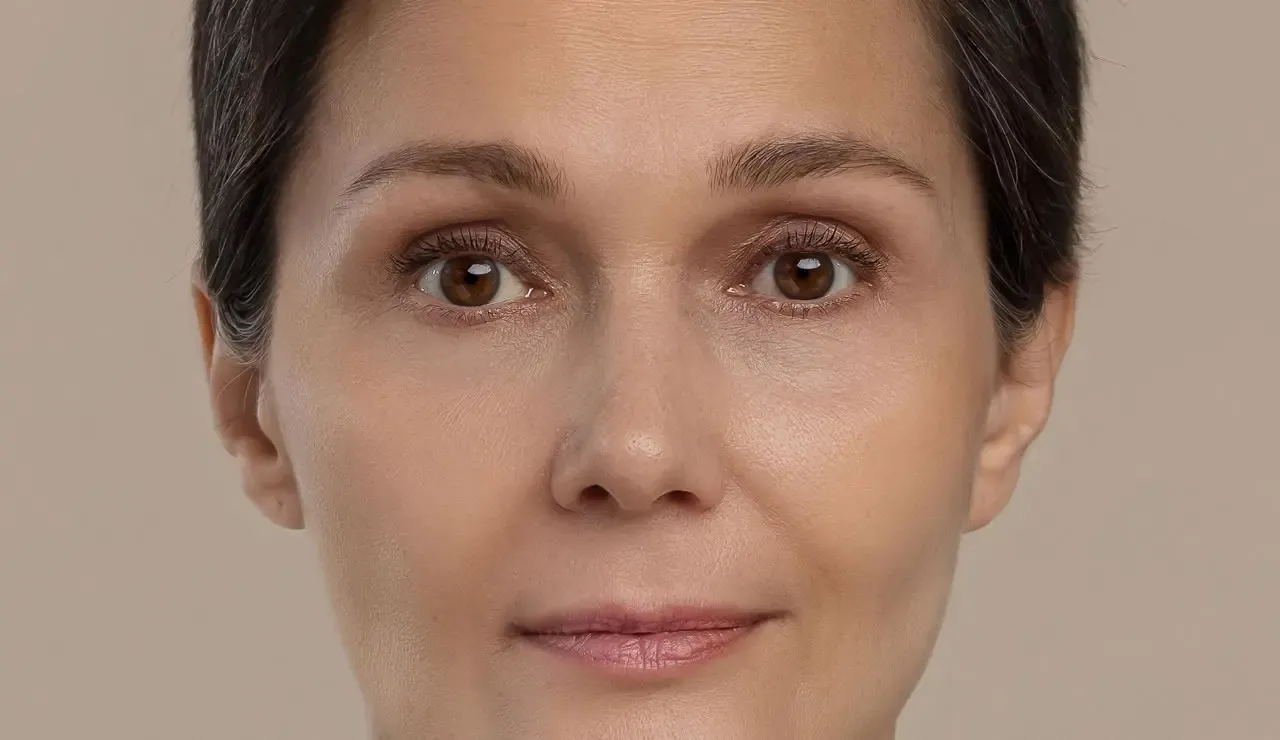 Microneedling Nachher bei JWC Kosmetik
