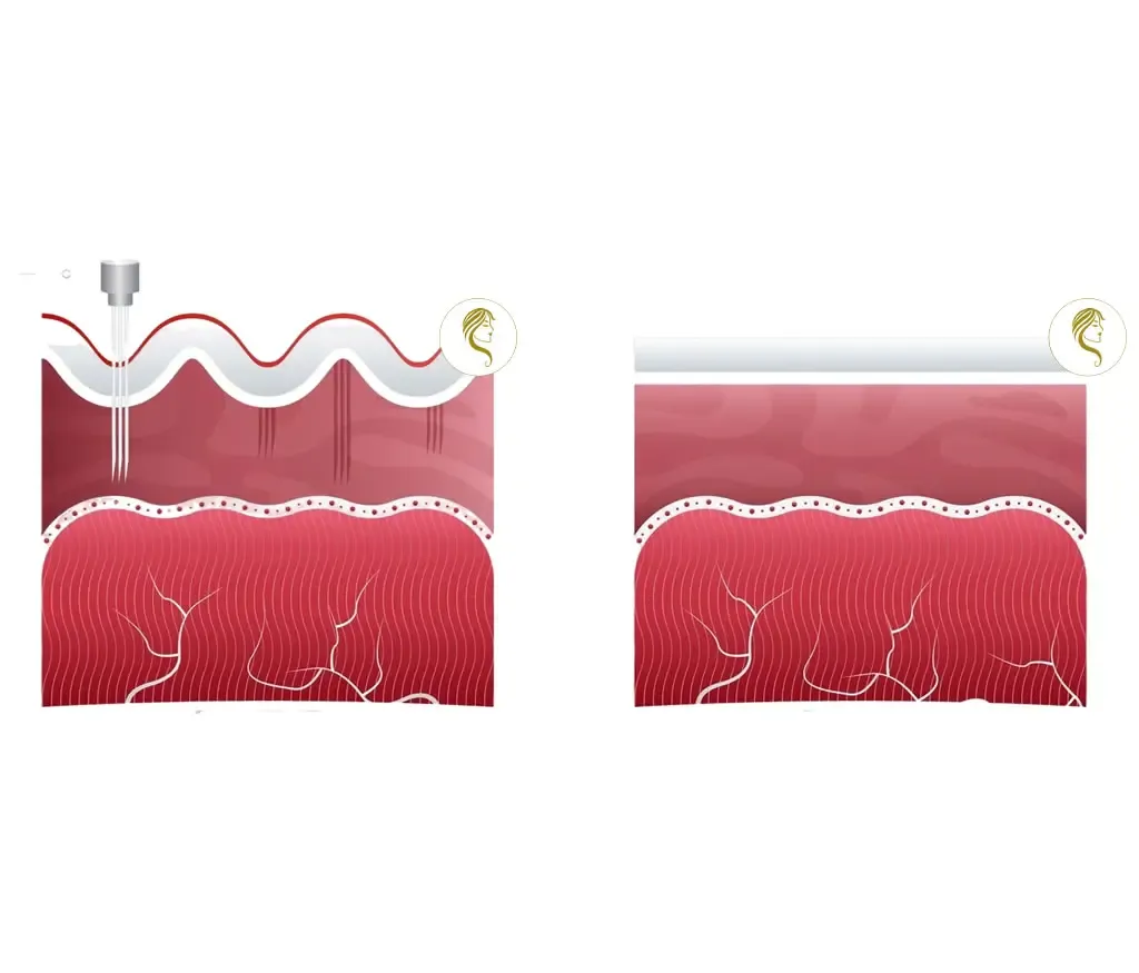 Ablauf des Microneedlings bei JWC Kosmetik