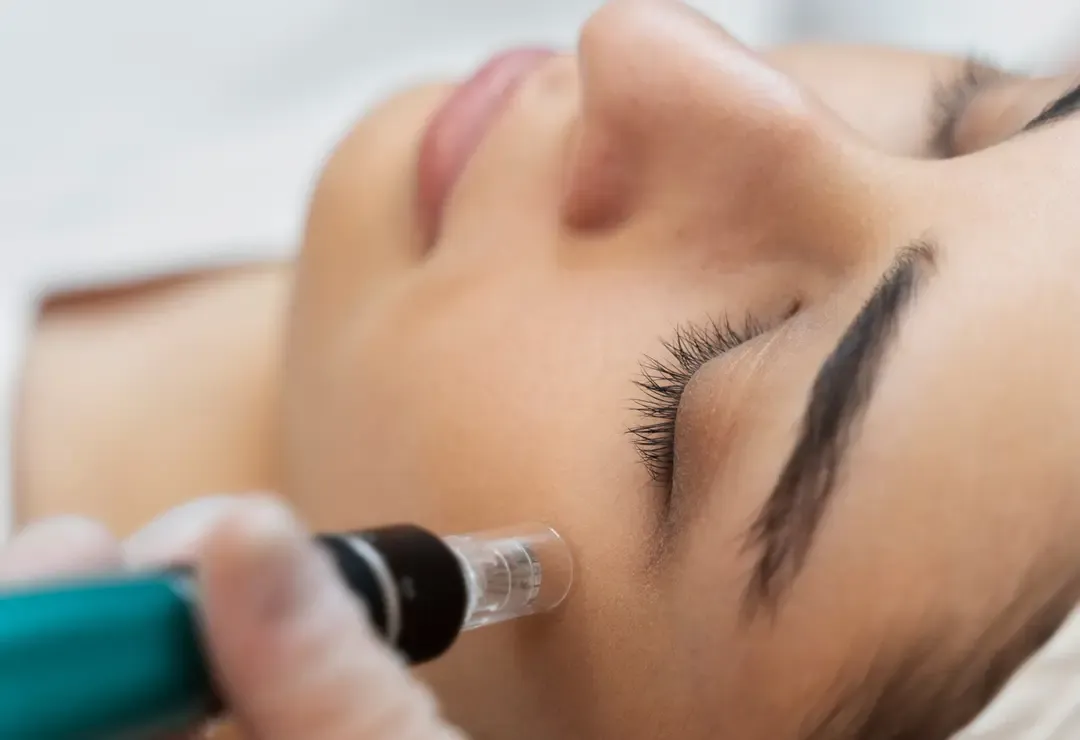 Microneedling bei JWC Kosmetik